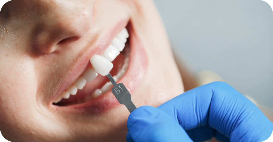 Коронка безметалловая из диоксида циркония