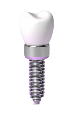 Имплантация зубов