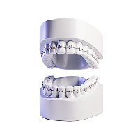 Исправление прикуса