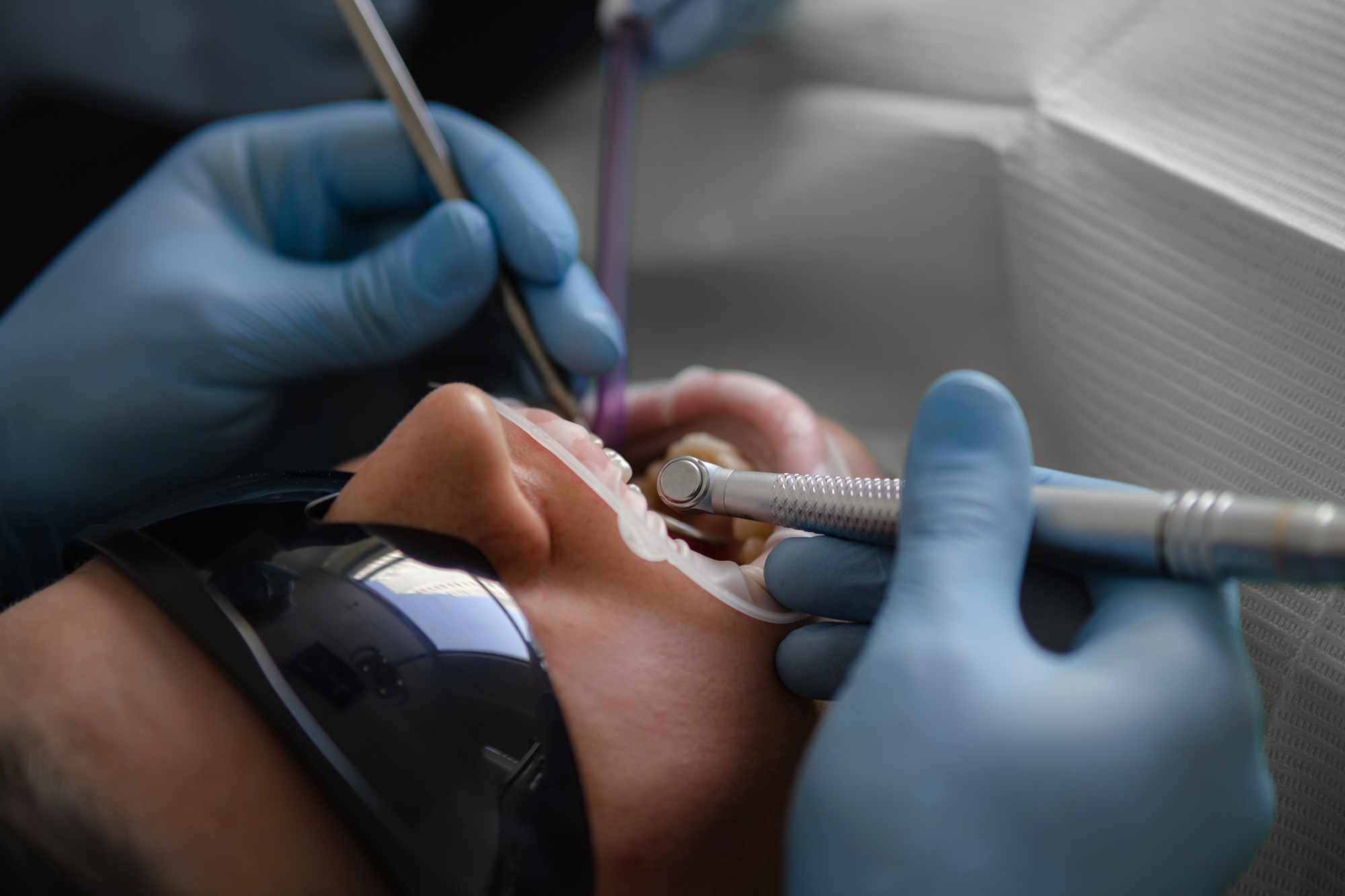 Кюретаж десен