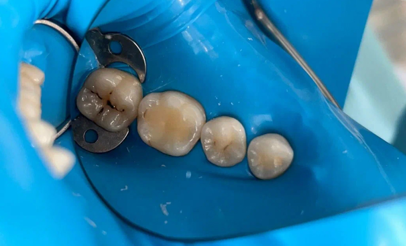 Лечение кариеса