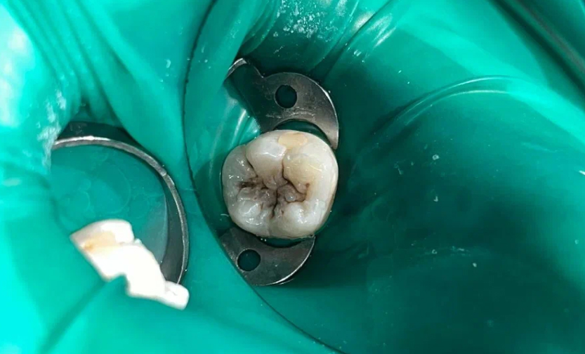 Лечение кариеса