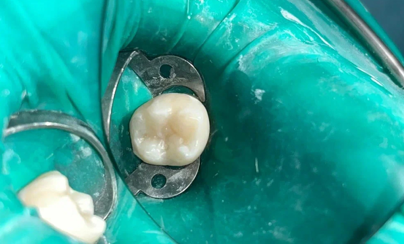 Лечение кариеса