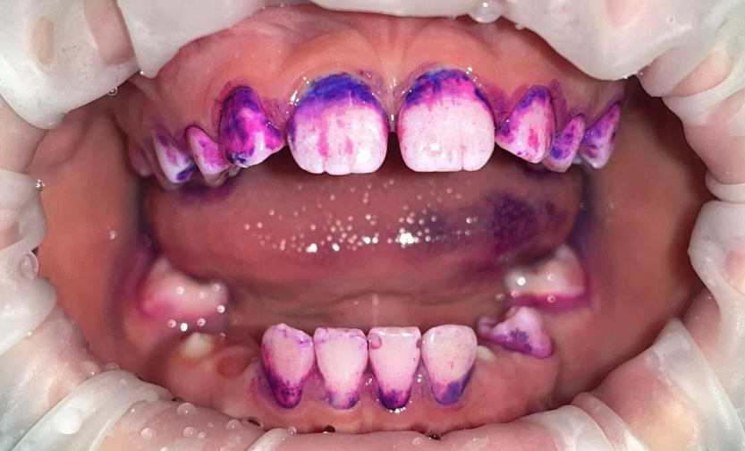 Профессиональная гигиена полости рта