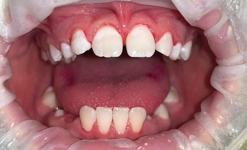 Профессиональная гигиена полости рта