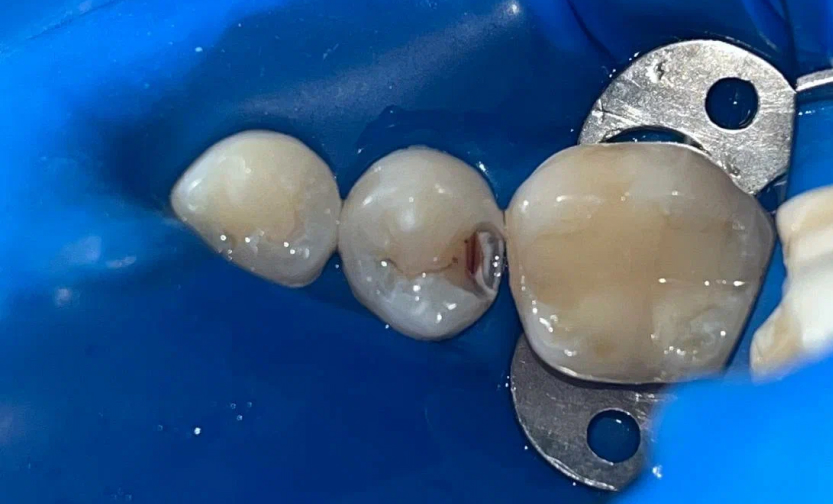 Лечение кариеса