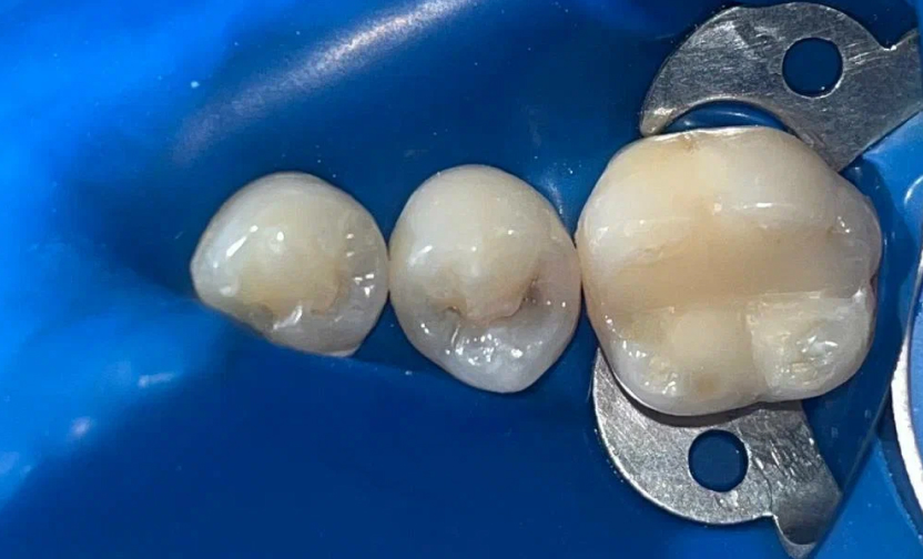 Лечение кариеса