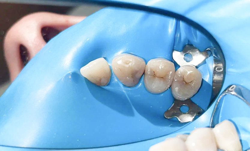 Лечение кариеса — до