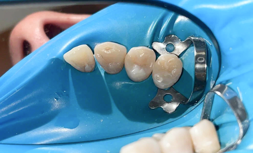 Лечение кариеса — после