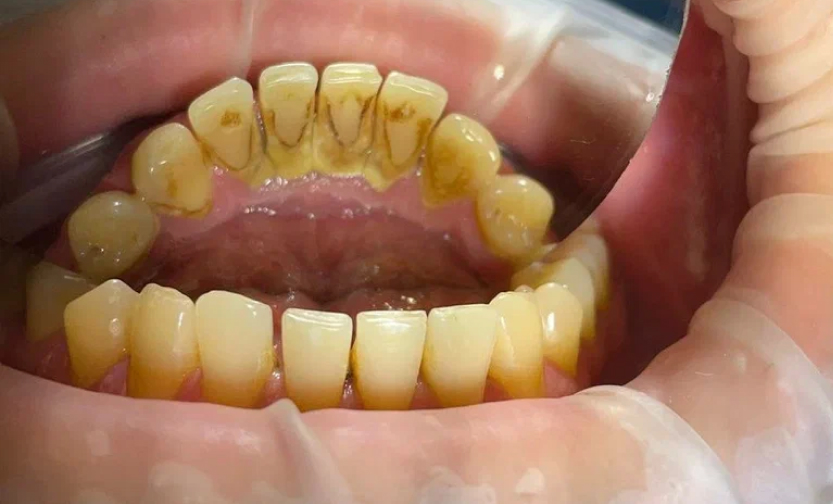 Профессиональная гигиена полости рта