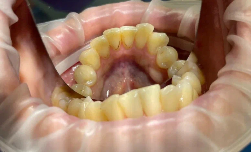 Профессиональная гигиена полости рта — до