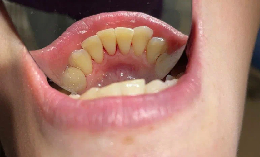 Профессиональная гигиена полости рта — после